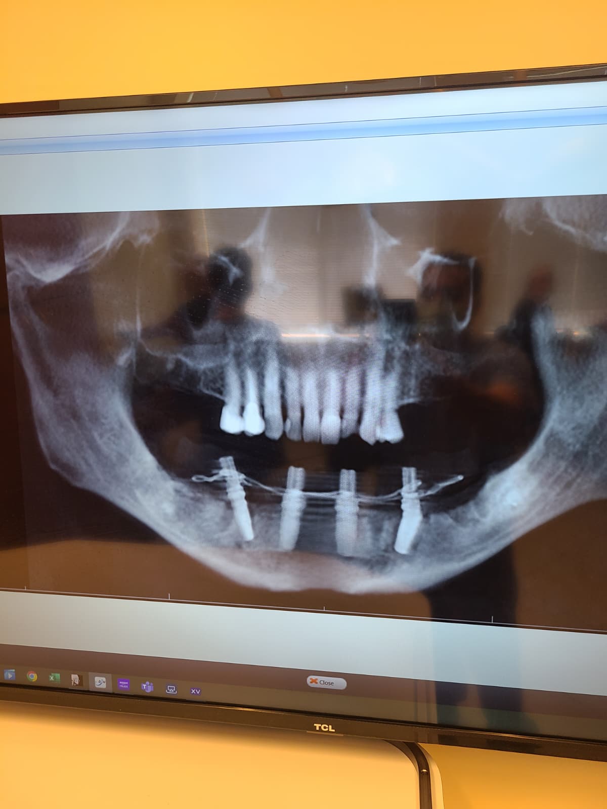 Multiple Full-Arch Restoration — after